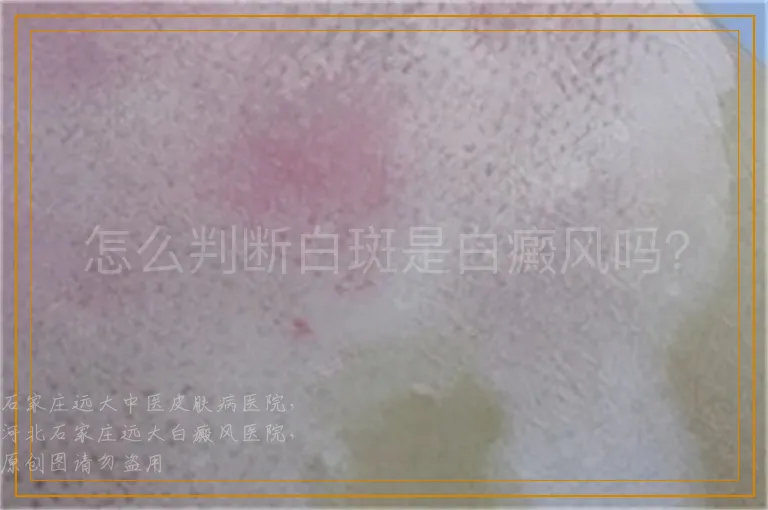 怎么判断白斑是白癜风吗？