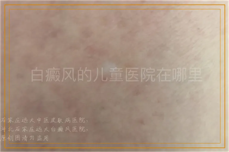 白癜风的儿童医院在哪里