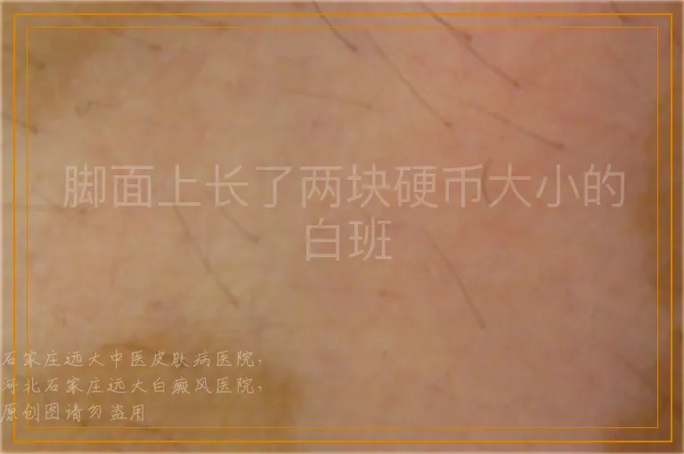 脚面上长了两块硬币大小的白班