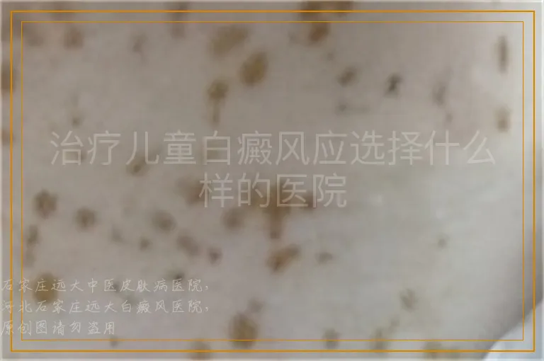 治疗儿童白癜风应选择什么样的医院