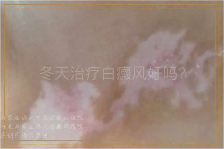 冬天治疗白癜风好吗？