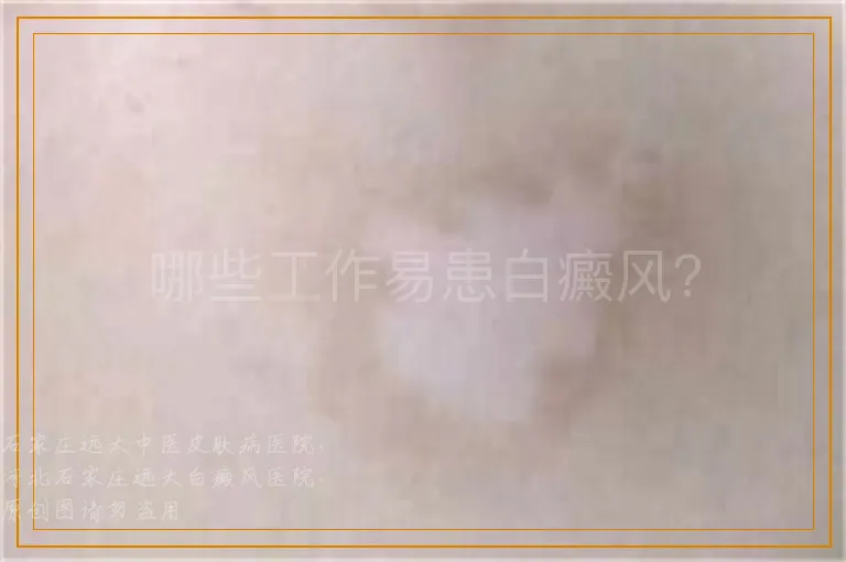 哪些工作易患白癜风？