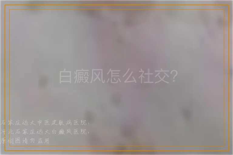 白癜风怎么社交？