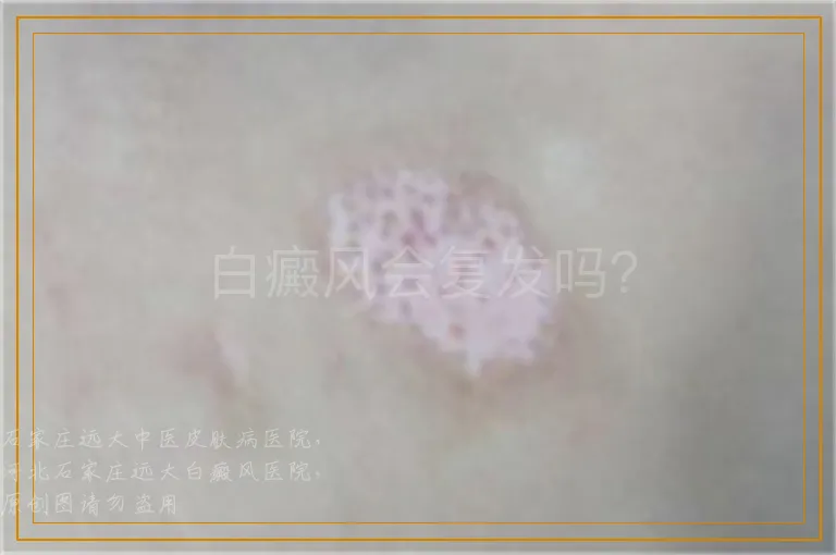 白癜风会复发吗？
