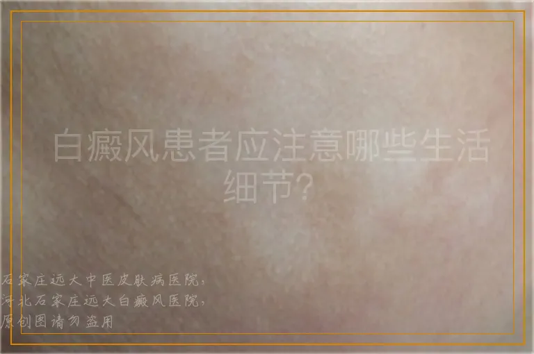 白癜风患者应注意哪些生活细节？
