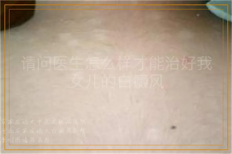 请问医生怎么样才能治好我女儿的白癜风