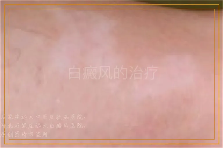 白癜风的治疗