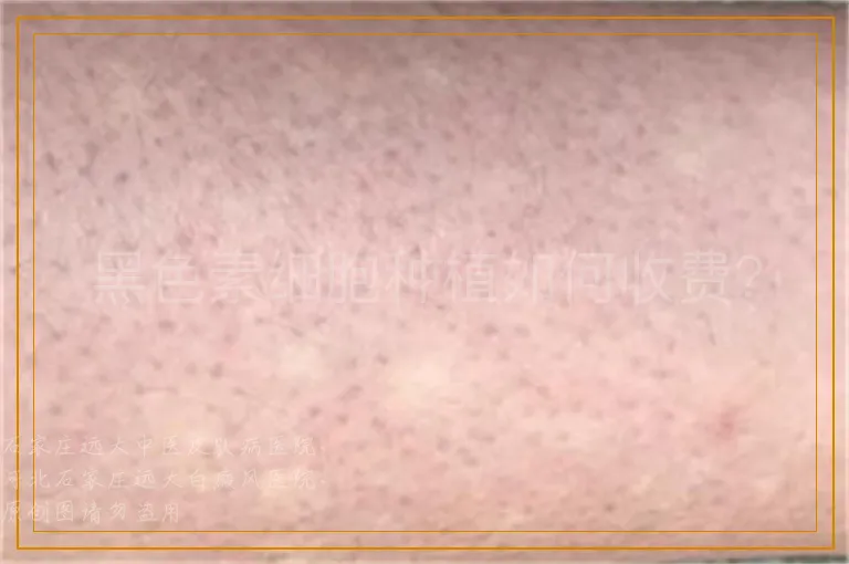 黑色素细胞种植如何收费？