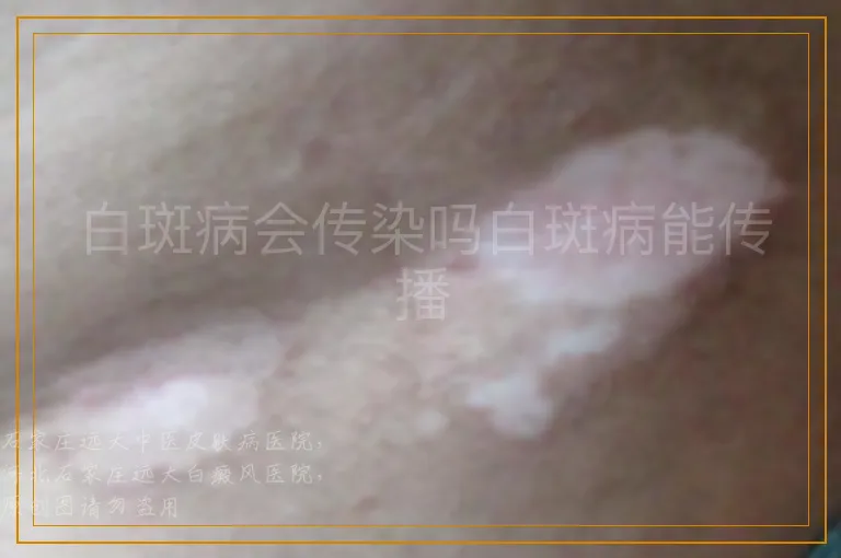 白斑病会传染吗白斑病能传播