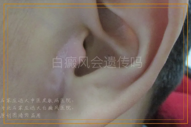 白癜风会遗传吗