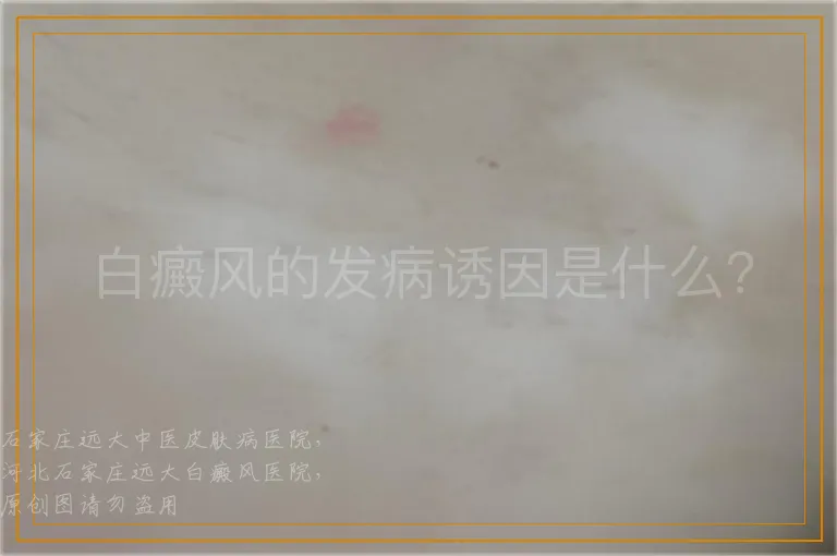 白癜风的发病诱因是什么？
