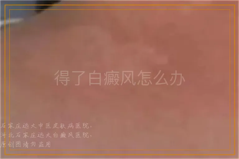 得了白癜风怎么办
