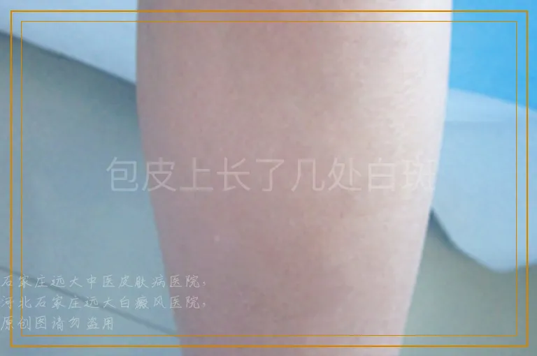 包皮上长了几处白斑