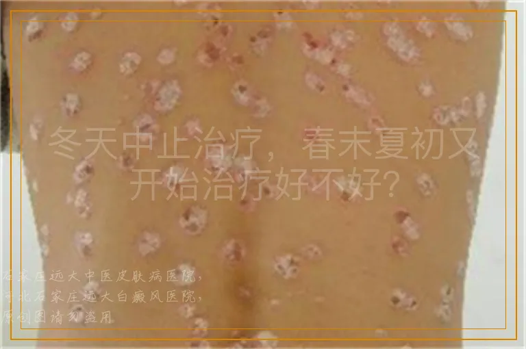 冬天中止治疗，春末夏初又开始治疗好不好？