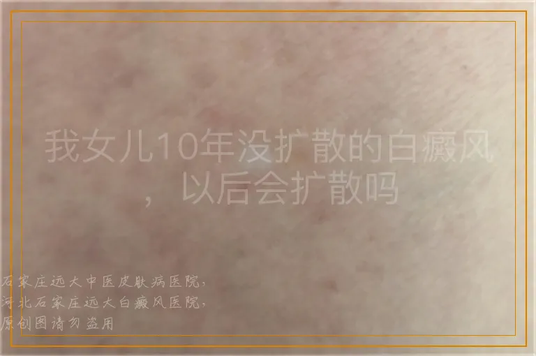 我女儿10年没扩散的白癜风，以后会扩散吗