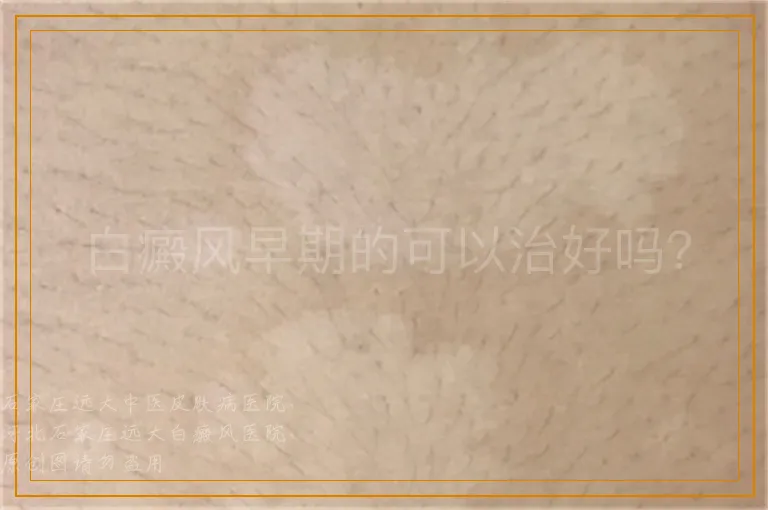 白癜风早期的可以治好吗？