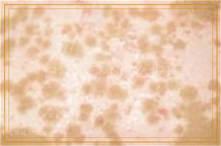 白癜风应该怎么护理