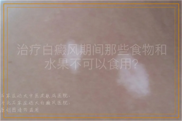 治疗白癜风期间那些食物和水果不可以食用？