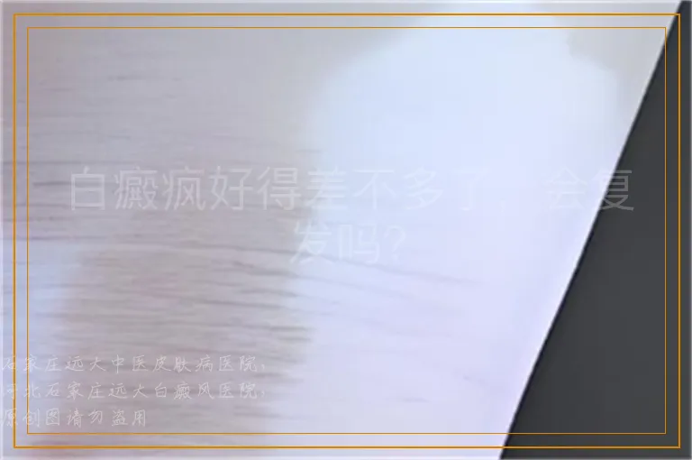 白癜疯好得差不多了，会复发吗？