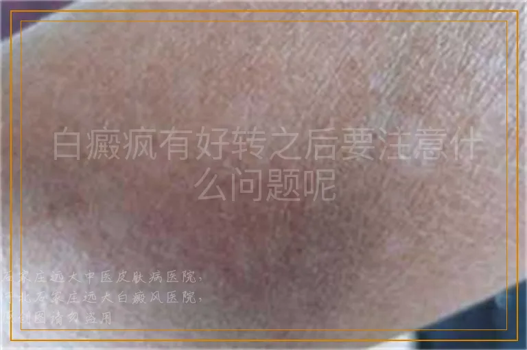 白癜疯有好转之后要注意什么问题呢