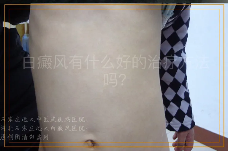 白癜风有什么好的治疗方法吗？