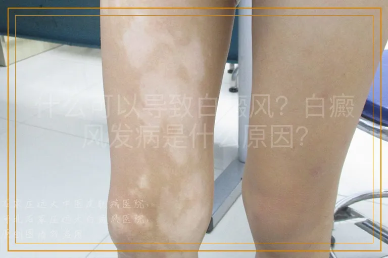 什么可以导致白癜风？白癜风发病是什么原因？