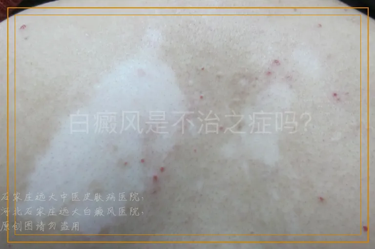 白癜风是不治之症吗？
