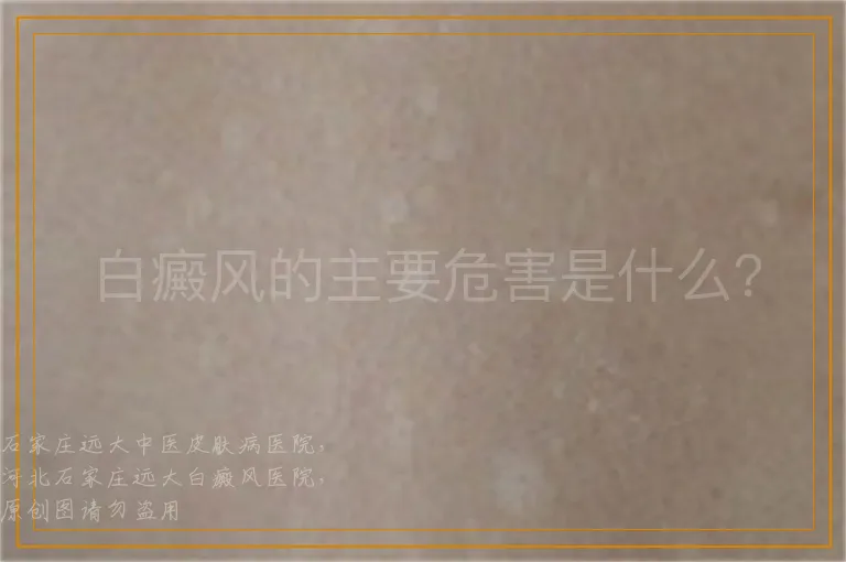 白癜风的主要危害是什么？