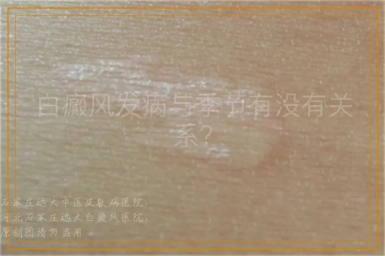 白癜风发病与季节有没有关系？