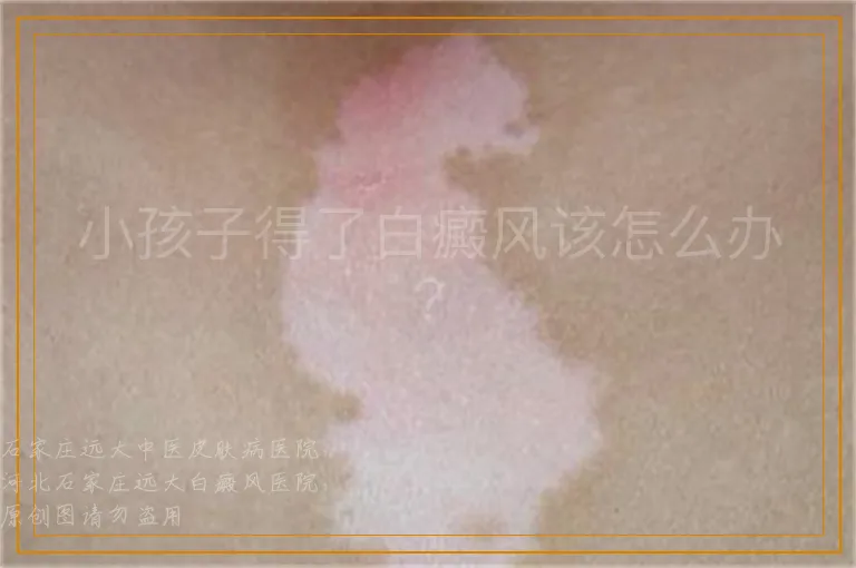小孩子得了白癜风该怎么办？