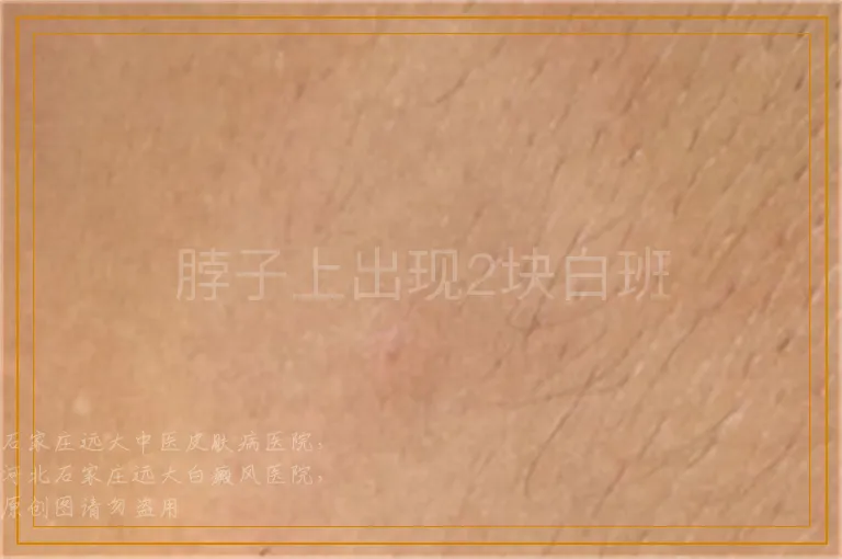 脖子上出现2块白班