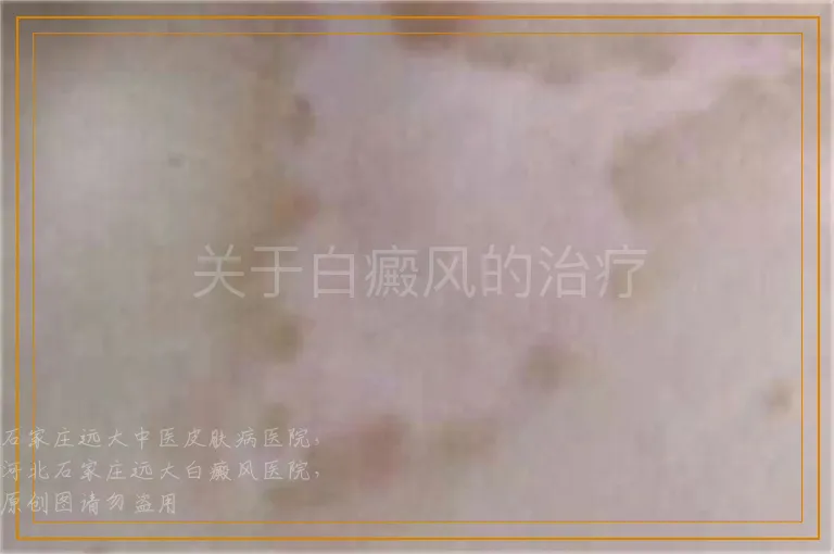 关于白癜风的治疗