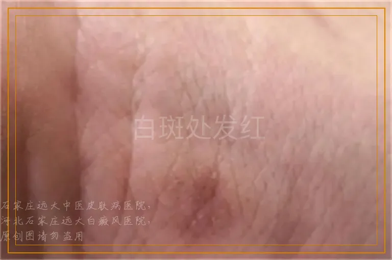 白斑处发红