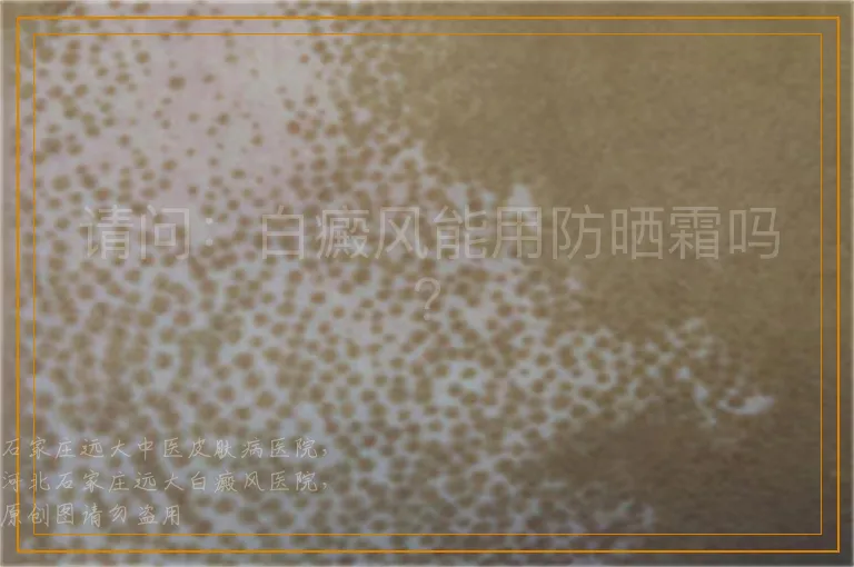 请问：白癜风能用防晒霜吗？