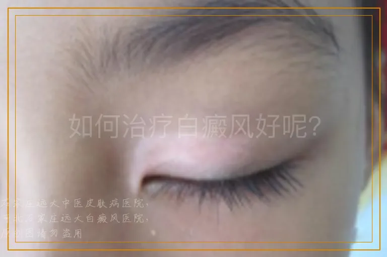 如何治疗白癜风好呢？