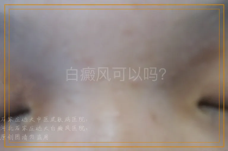 白癜风可以吗？