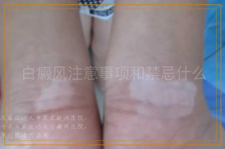 白癜风注意事项和禁忌什么