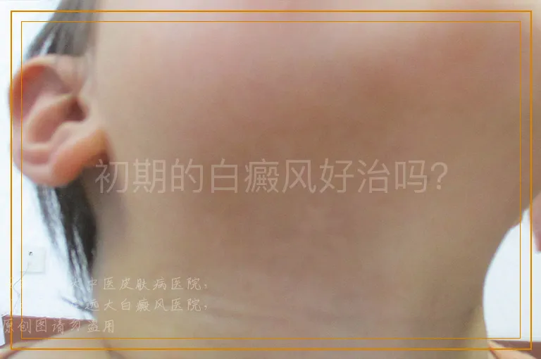 初期的白癜风好治吗？