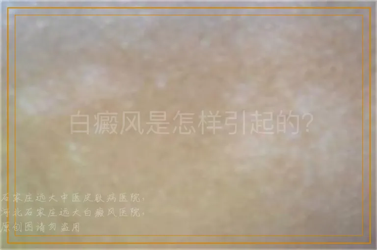 白癜风是怎样引起的？