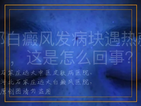局部白癜风发病块遇热就痒，这是怎么回事？