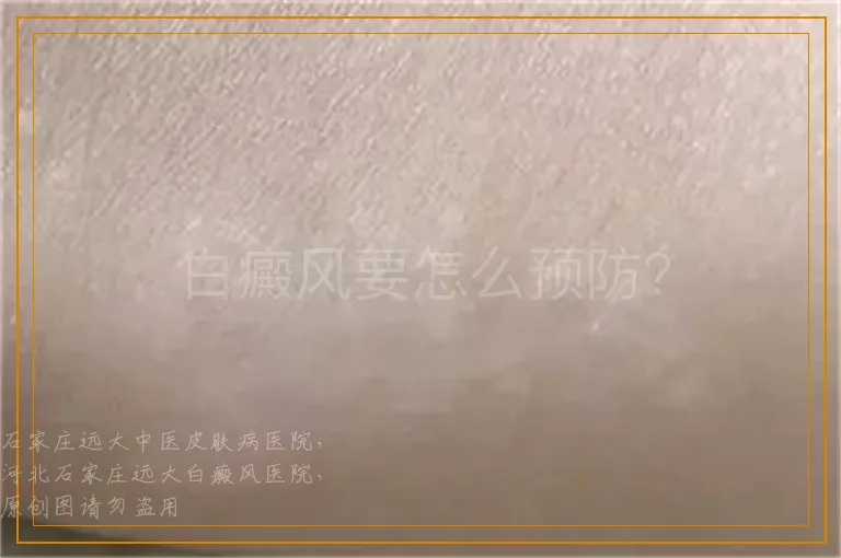 白癜风要怎么预防？
