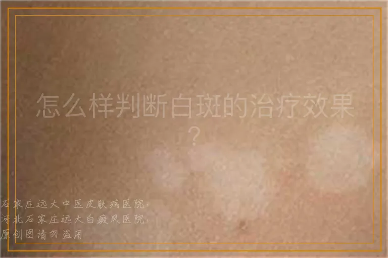 怎么样判断白斑的治疗效果？