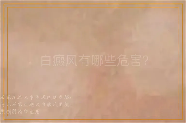 白癜风有哪些危害？