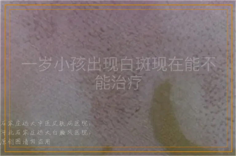 一岁小孩出现白斑现在能不能治疗
