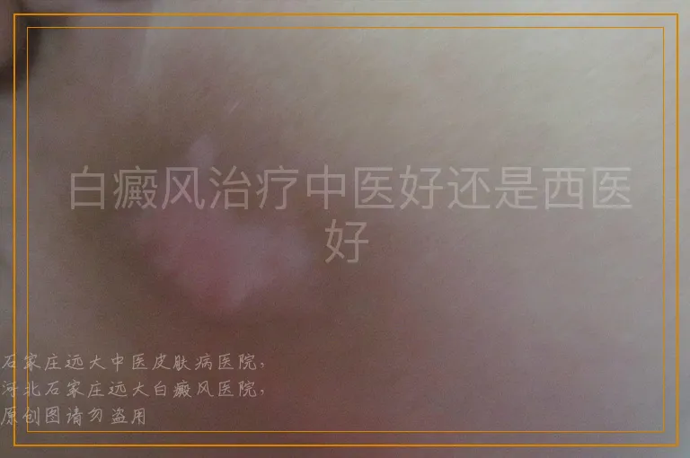 白癜风治疗中医好还是西医好