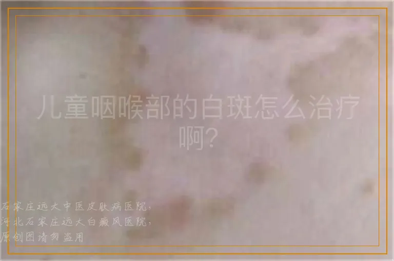 儿童咽喉部的白斑怎么治疗啊？