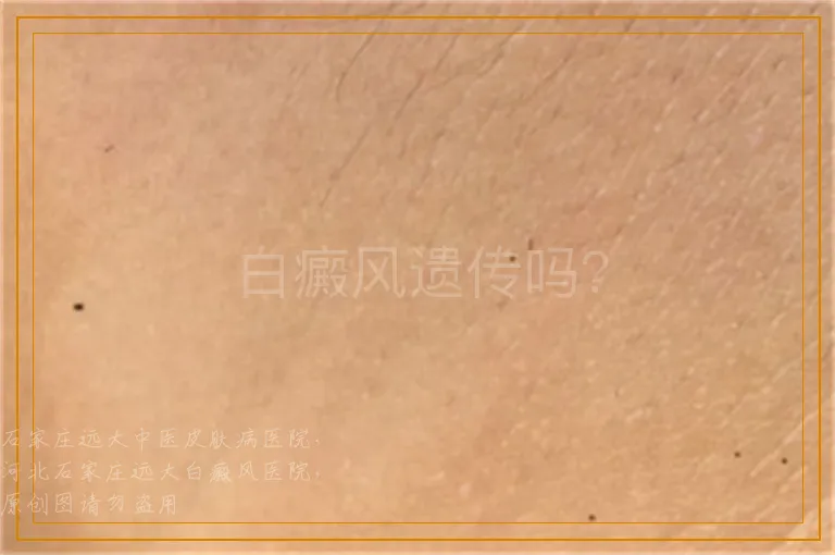 白癜风遗传吗？