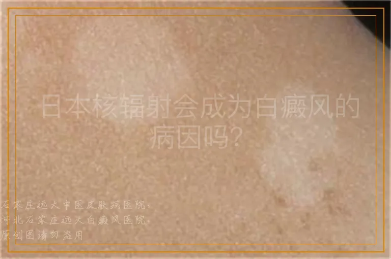 日本核辐射会成为白癜风的病因吗？