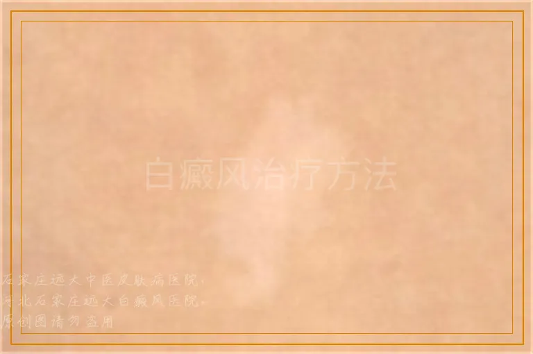 白癜风治疗方法