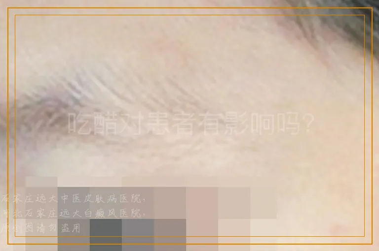 吃醋对患者有影响吗？